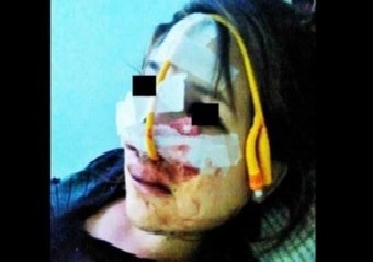 mujer golpeada desfigurada